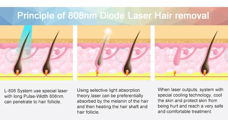 2025 Newest 808nm Diode ICE Platinum Diode Hair Removal Machine 755 808 1064nm hair remove hair