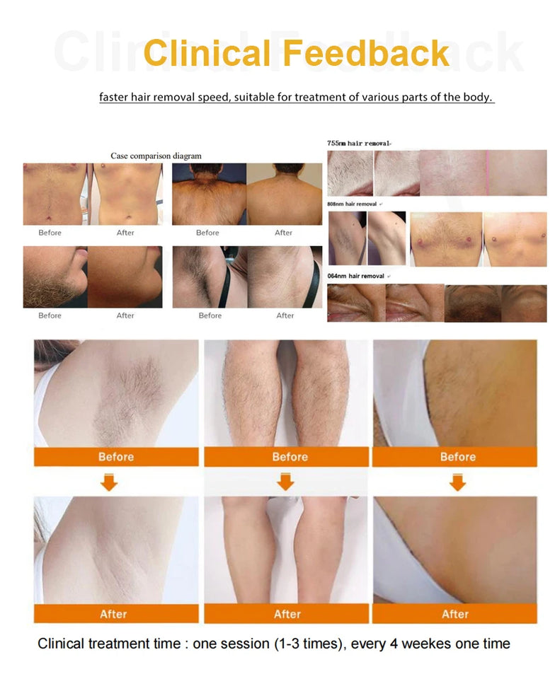 2025 Newest 808nm Diode ICE Platinum Diode Hair Removal Machine 755 808 1064nm hair remove hair