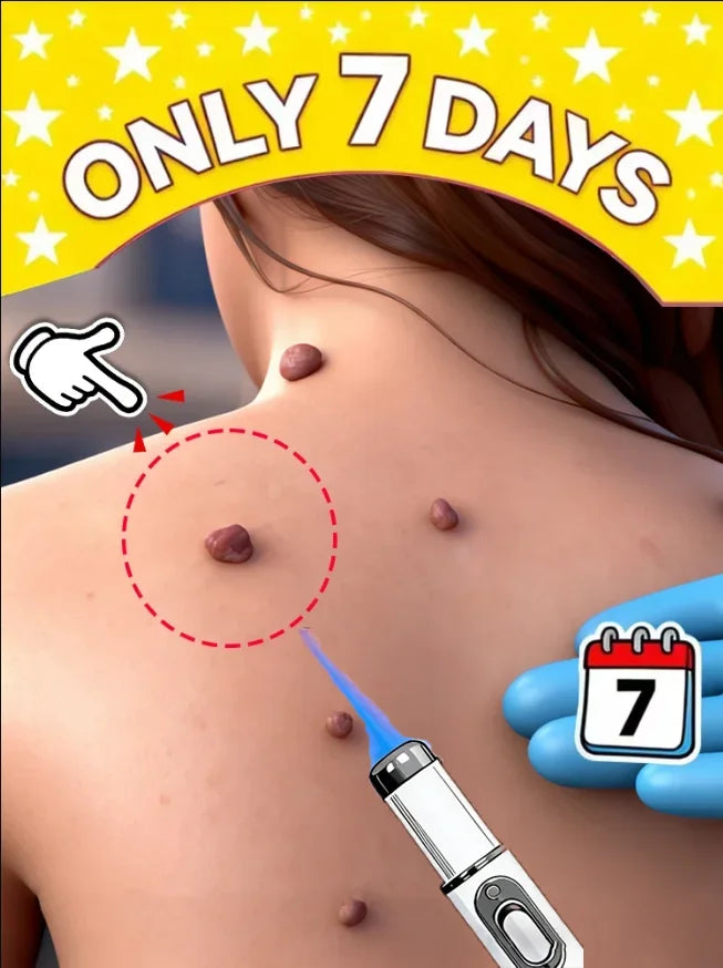 2026 new model, 5th ¹⁰⁰% ᵉᶠᶠᵉᶜᵗⁱᵛᵉ Blue light wart removal tool, more discounts on sets