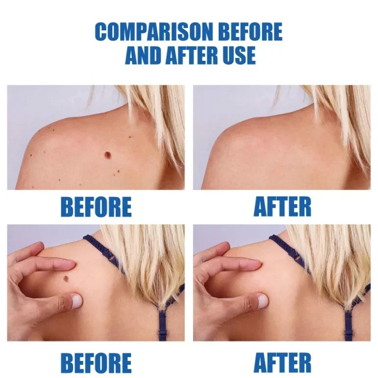 2026 new model, 5th ¹⁰⁰% ᵉᶠᶠᵉᶜᵗⁱᵛᵉ Blue light wart removal tool, more discounts on sets