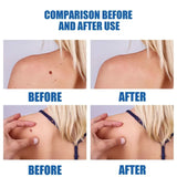 2026 new model, 5th ¹⁰⁰% ᵉᶠᶠᵉᶜᵗⁱᵛᵉ Blue light wart removal tool, more discounts on sets