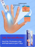 2025 New Upgrade Blue Laser Solve Wart Tool
