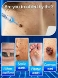 2026 new model, 5th ¹⁰⁰% ᵉᶠᶠᵉᶜᵗⁱᵛᵉ Blue light wart removal tool, more discounts on sets
