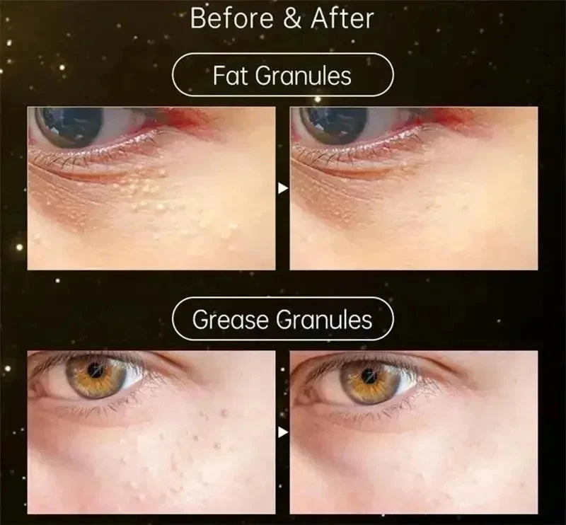 Fat Granules Remover Eye Cream Effective Remove Fat Granules Puffiness Anti-Particles Milia Remover Product Repair Eye Skin Care