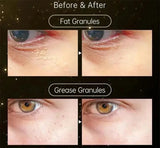 Fat Granules Remover Eye Cream Effective Remove Fat Granules Puffiness Anti-Particles Milia Remover Product Repair Eye Skin Care