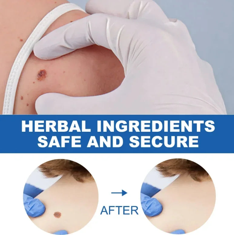 2026 new model, 5th ¹⁰⁰% ᵉᶠᶠᵉᶜᵗⁱᵛᵉ Blue light wart removal tool, more discounts on sets